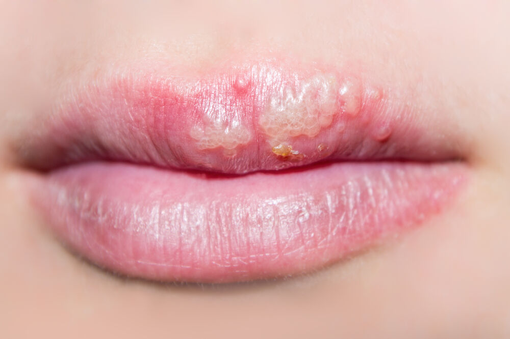 herpes, Foto: Shutterstock