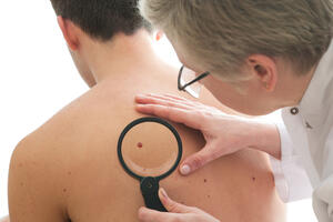 Ovo su upozorenja na rak kože koja ne bi trebalo ignorisati