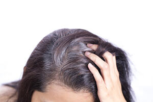 Sijeda kosa nije povezana sa stresom