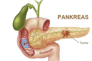 Nemogućnost ranog otkrivanja raka pankreasa uzrokuje veću smrtnost