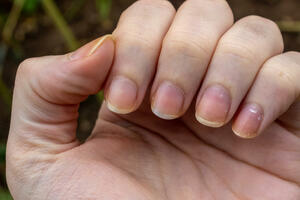 Žuti nokti- razlog za brigu ili ne?