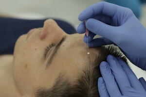 Inovativni tretman koji rješava i najteže stadijume gubitka kose