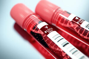 Test krvi na 50 vrsta karcinoma mogao bi da ubrza postavljanje...