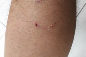 Podgoričanina ujeo pas lutalica u blizini stadiona