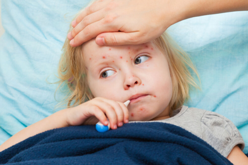 boginje, varičele, Foto: Shutterstock.com