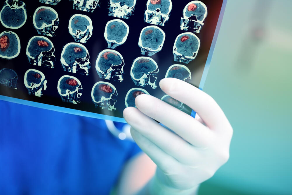 tumor na mozgu, kancer, Foto: Shutterstock