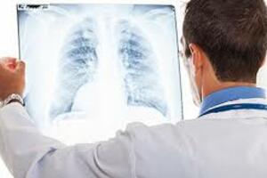 Simptomi upale pluća koje možda niste znali