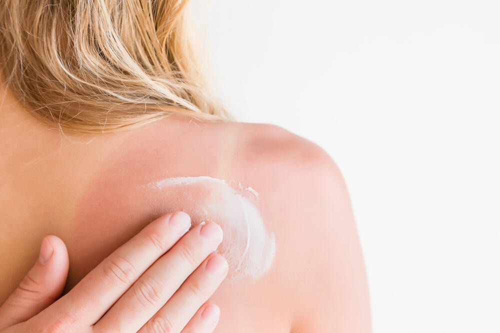 opekotine, Foto: Shutterstock