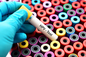Najčešče prenosiva polna bolest: Šta je to HPV