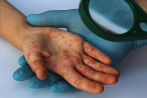 U Crnoj Gori od malih boginja oboljele 173 osobe