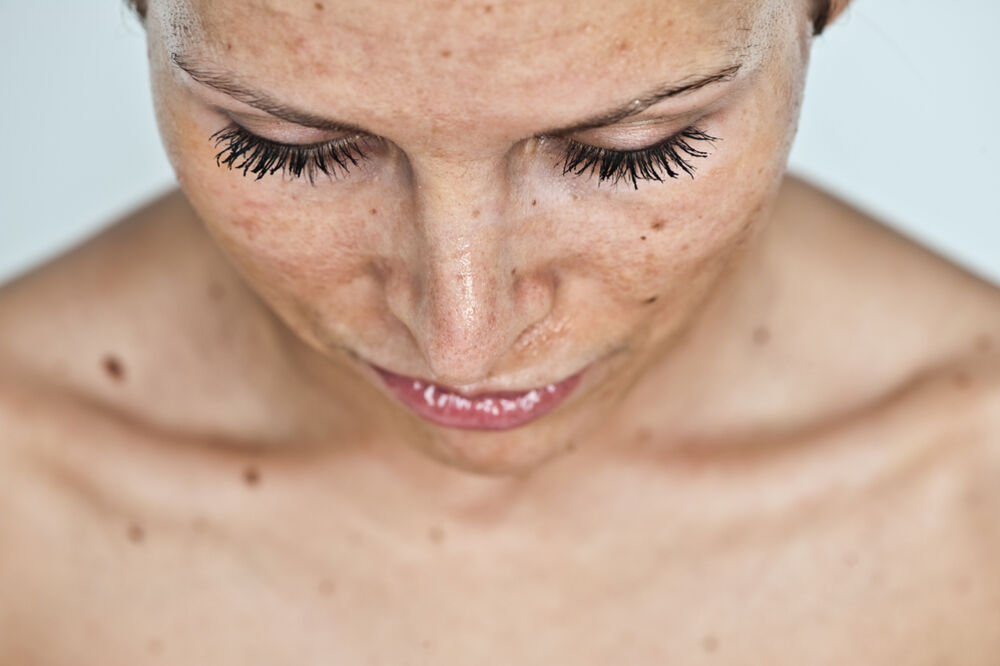 lice, pjege, Foto: Shutterstock