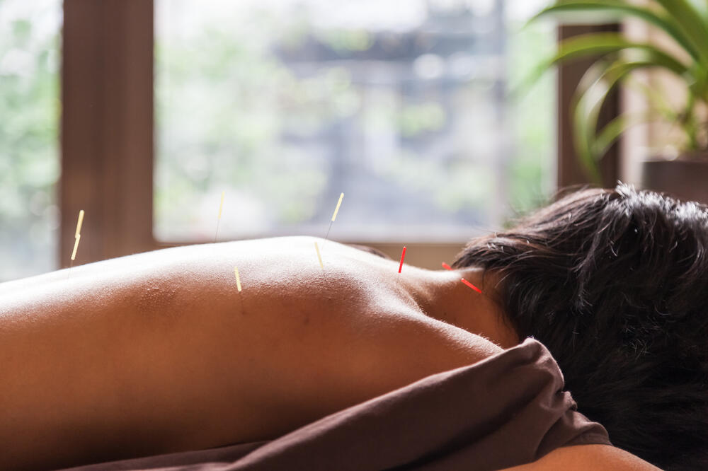akupunktura, Foto: Shutterstock