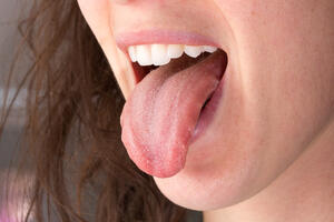 Promjene u ustima i na jeziku: Loša higijena ili upozorenje?