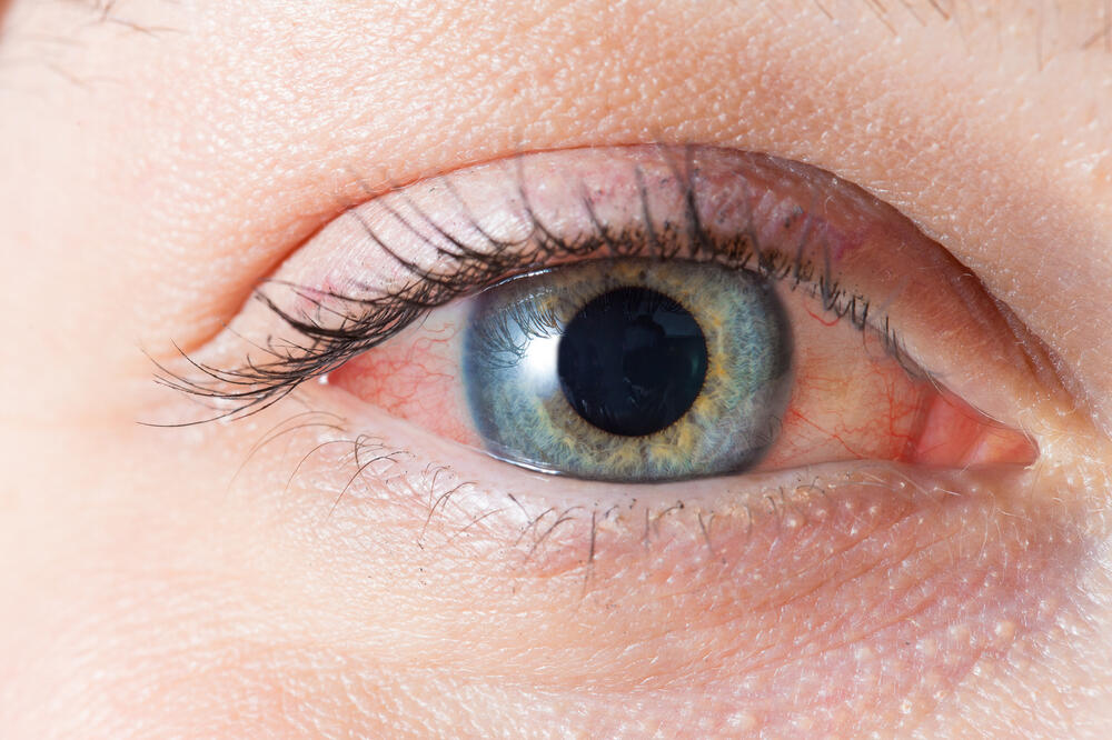 crvene oči, krvave oči, Foto: Shutterstock