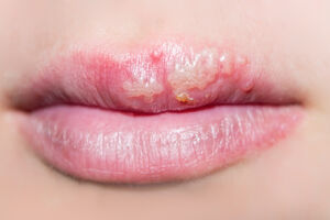 Herpes - jedna od najčešćih virusnih bolesti kože