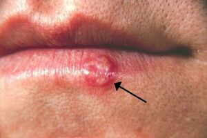 Herpes: Kako nastaje i kako se liječi?