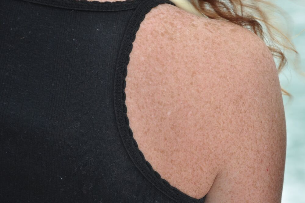 koža, pjege, Foto: Shutterstock