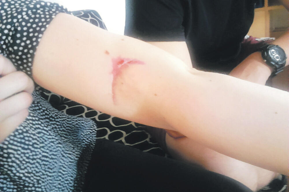 Ujed psa, Foto: Arhiva Vijesti