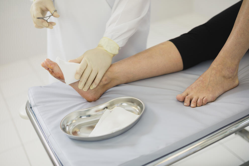 opekotine, rana, Foto: Shutterstock