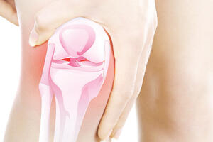 Krckanje i škripanje koljena  - znak artroze