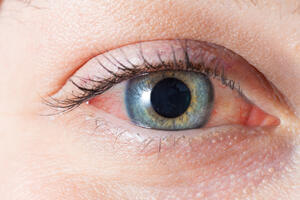 Šest najčešćih razloga krvavih očiju