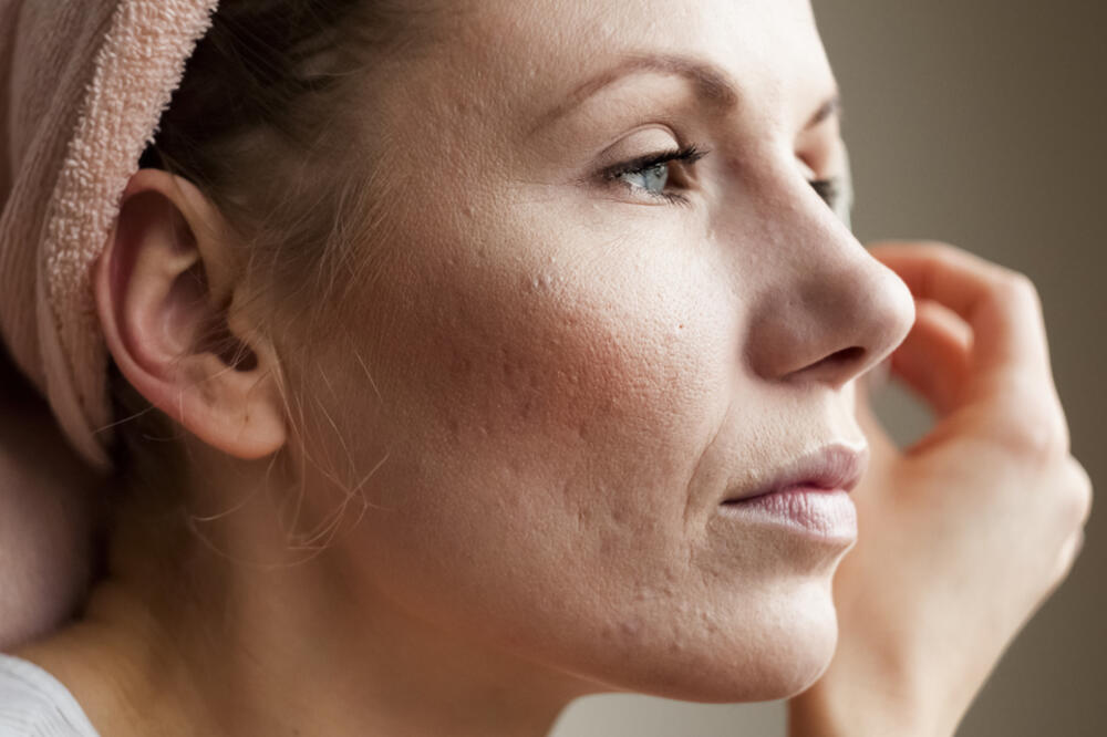 lice, akne, Foto: Shutterstock