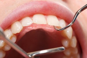 Dentalna fluoroza ili bijele mrlje na zubima