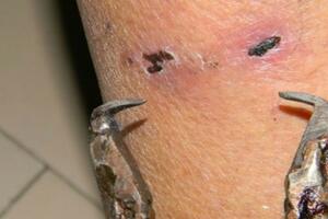 Sombor: Kliještima povrjeđivao ljude kako bi dobili odštetu za...