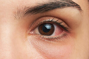 Šminka najčešći izvor infekcije očiju