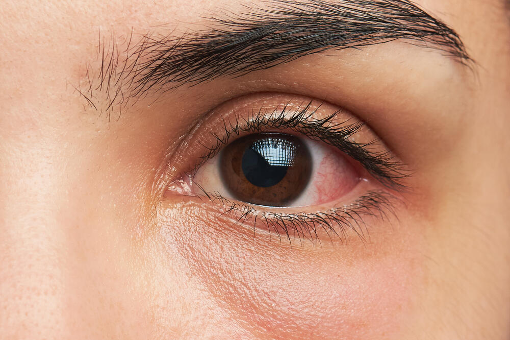 oči, oko, infekcija, Foto: Shutterstock