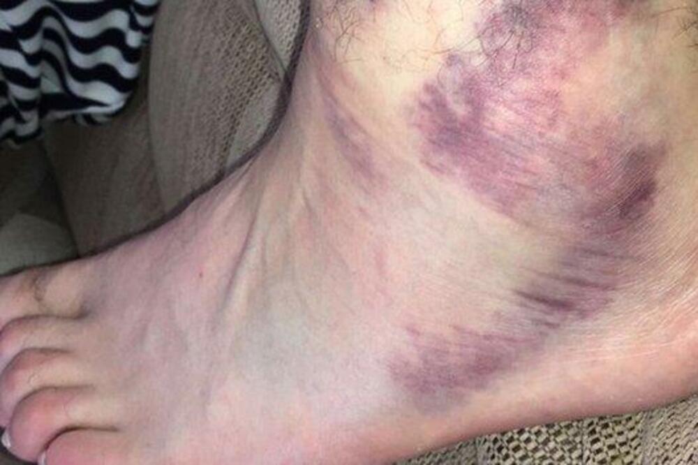 Tajson Fjuri skočni zglob, Foto: Twitter