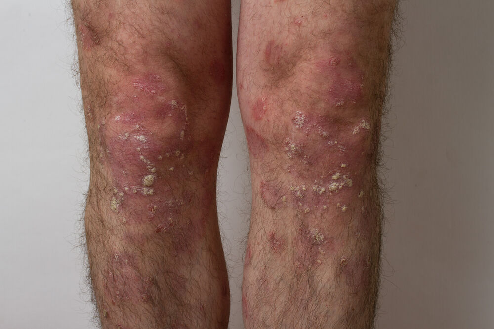 psorijaza, Foto: Shutterstock