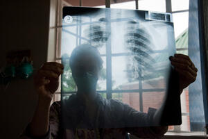 Srbija: Počinje primjena kubanskog lijeka za adenokarcinoma pluća