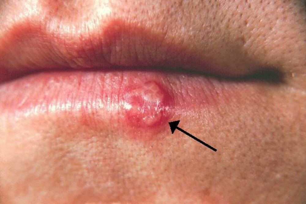 herpes, Foto: Wikipedia