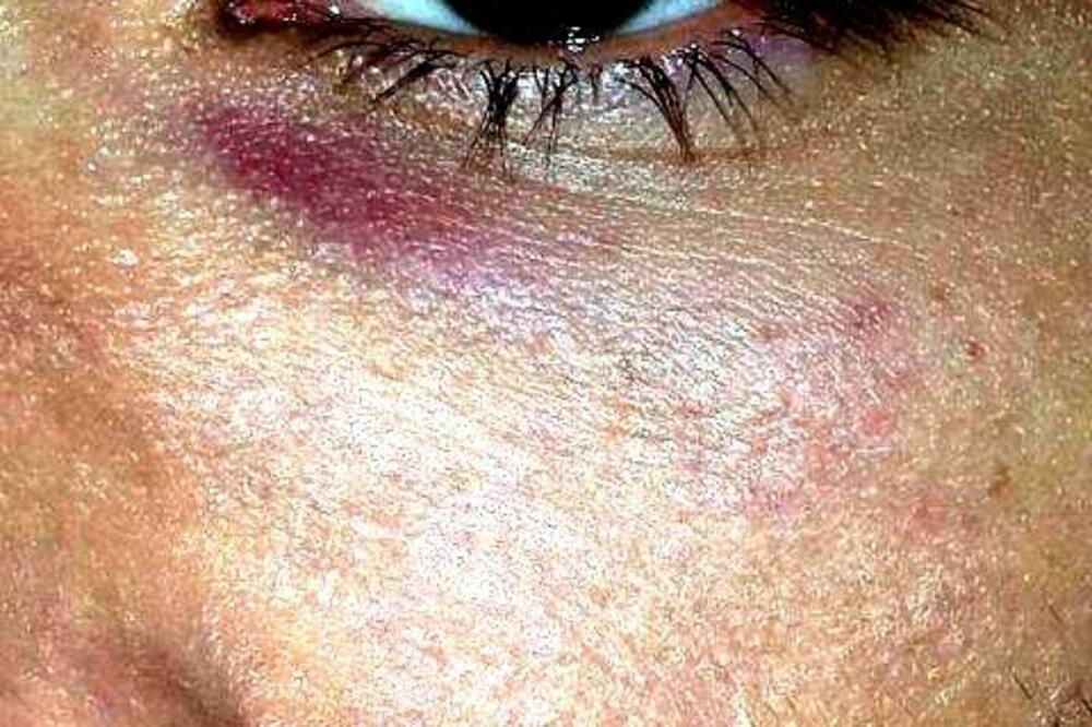 LGBT osoba napad, Foto: LGBT Forum Progres