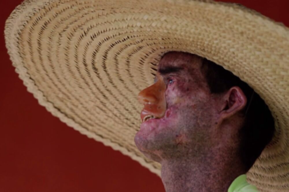 Xeroderma Pigmentosum, Foto: Screenshot (YouTube)