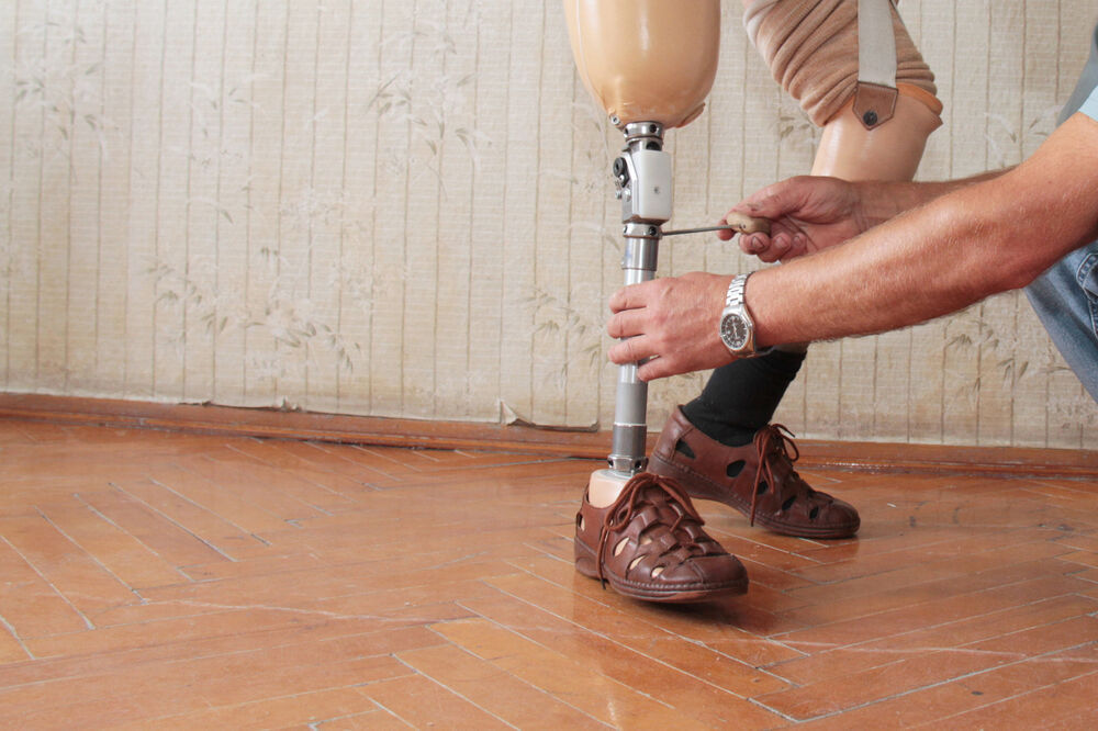 Vještačka noga, Foto: Shutterstock