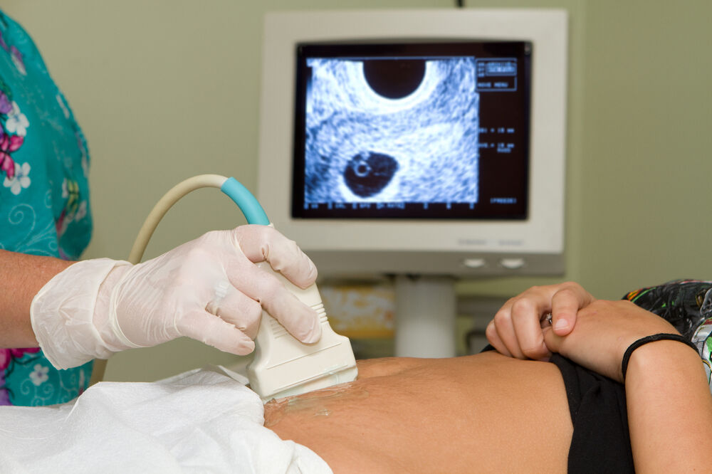 trudnoća, abortus, Foto: Shutterstock
