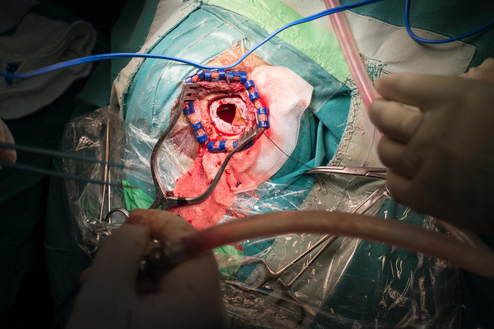 rak mozgda, operacija, Foto: Shutterstock