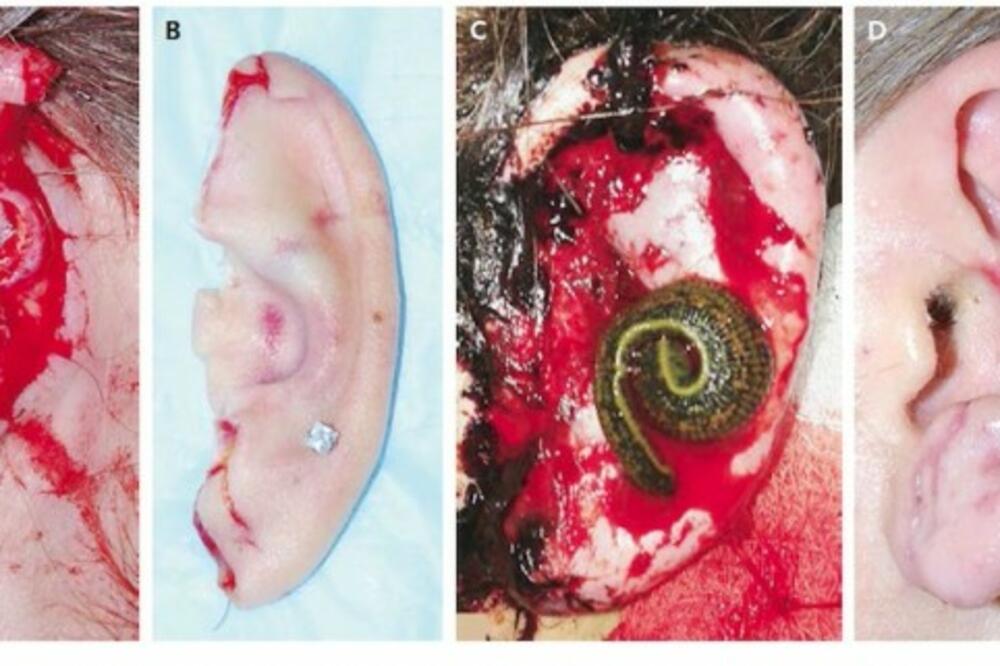 rekonstrukcija uva, Foto: The New England Journal of Medicine