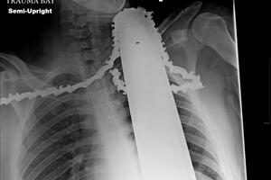 Došao u bolnicu s motornom testerom u vratu