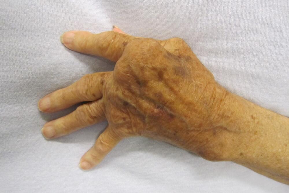 reumatoidni artritis, Foto: En.wikipedia.org