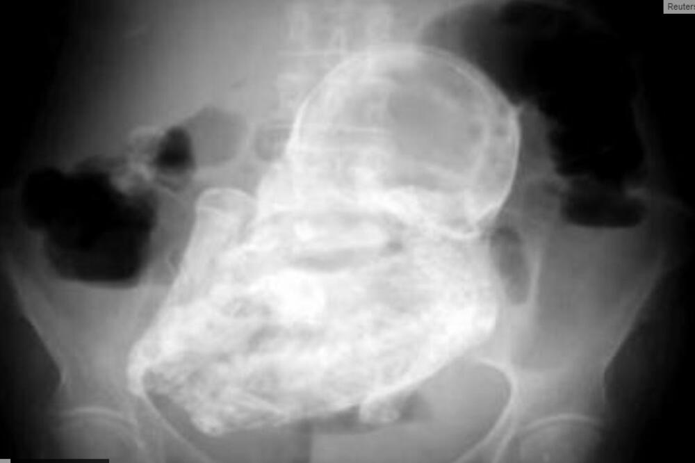 skamenjeni fetus, Foto: Reuters