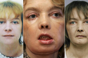Izabel je prva osoba kojoj je presađeno lice: Kad ljudi bulje u...