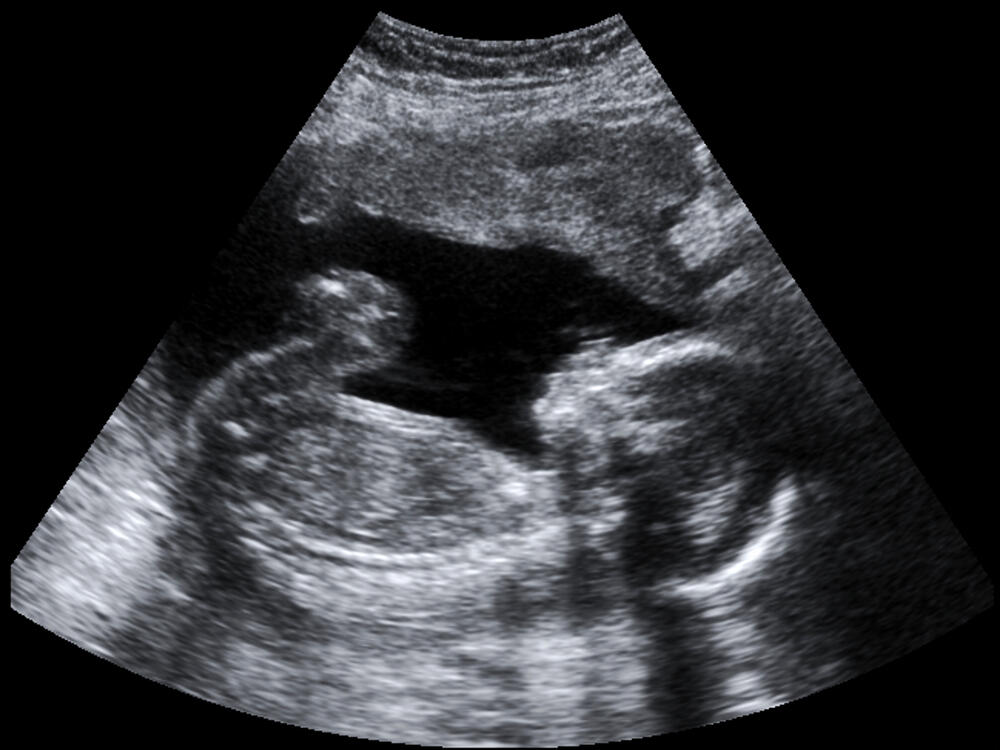 ultrazvuk, beba