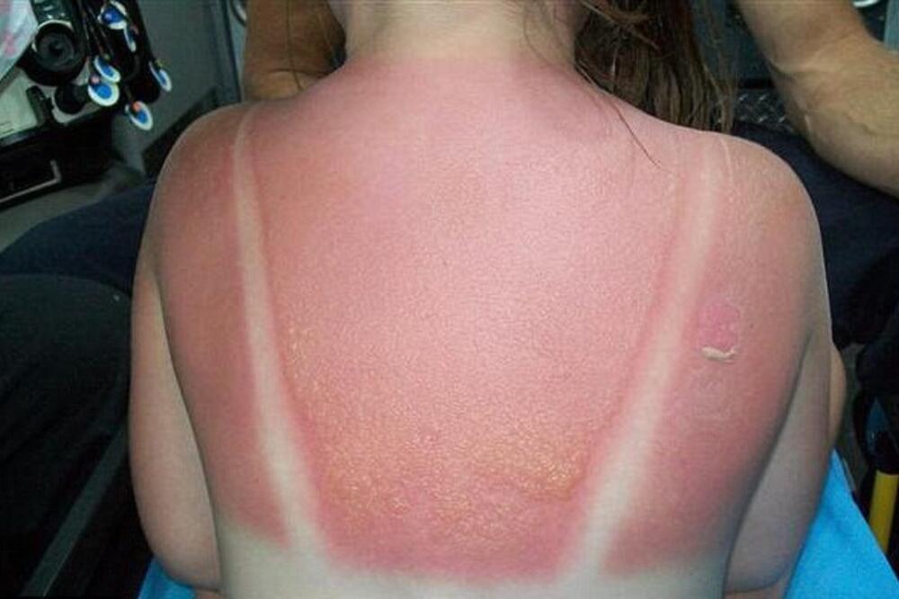 opekotine, Foto: Dailymail.co.uk