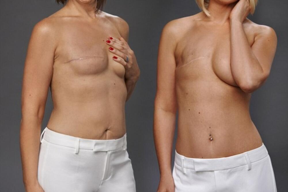 rak dojke, mastektomija, Foto: Dailymail.co.uk