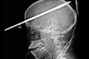 Ispalio sebi harpun u glavu i preživio