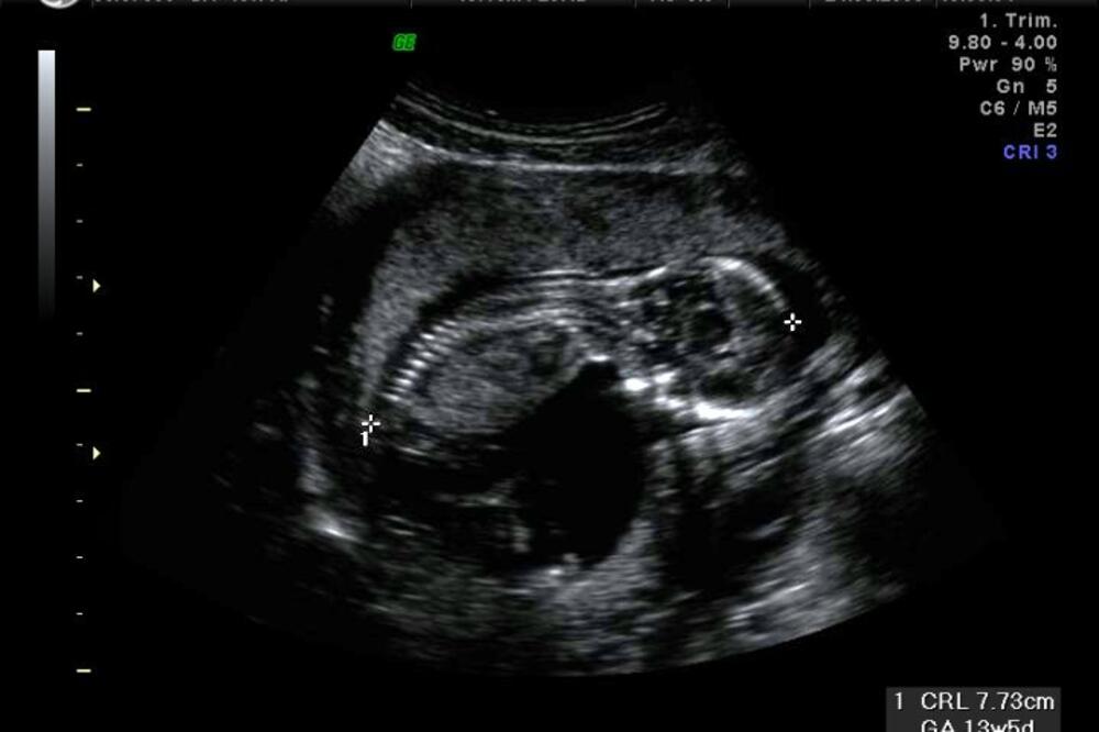 ultrazvuk, Foto: Kiwi.logix.cz