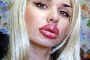 Vlasnica najvećih silikonskih usana na svijetu želi još botoksa